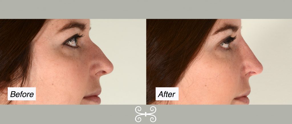 non-surgical nose job